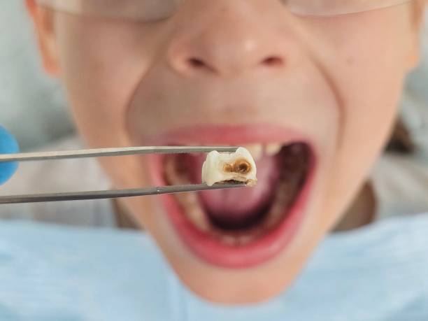 Best Emergency Tooth Extraction in Ethete, WY